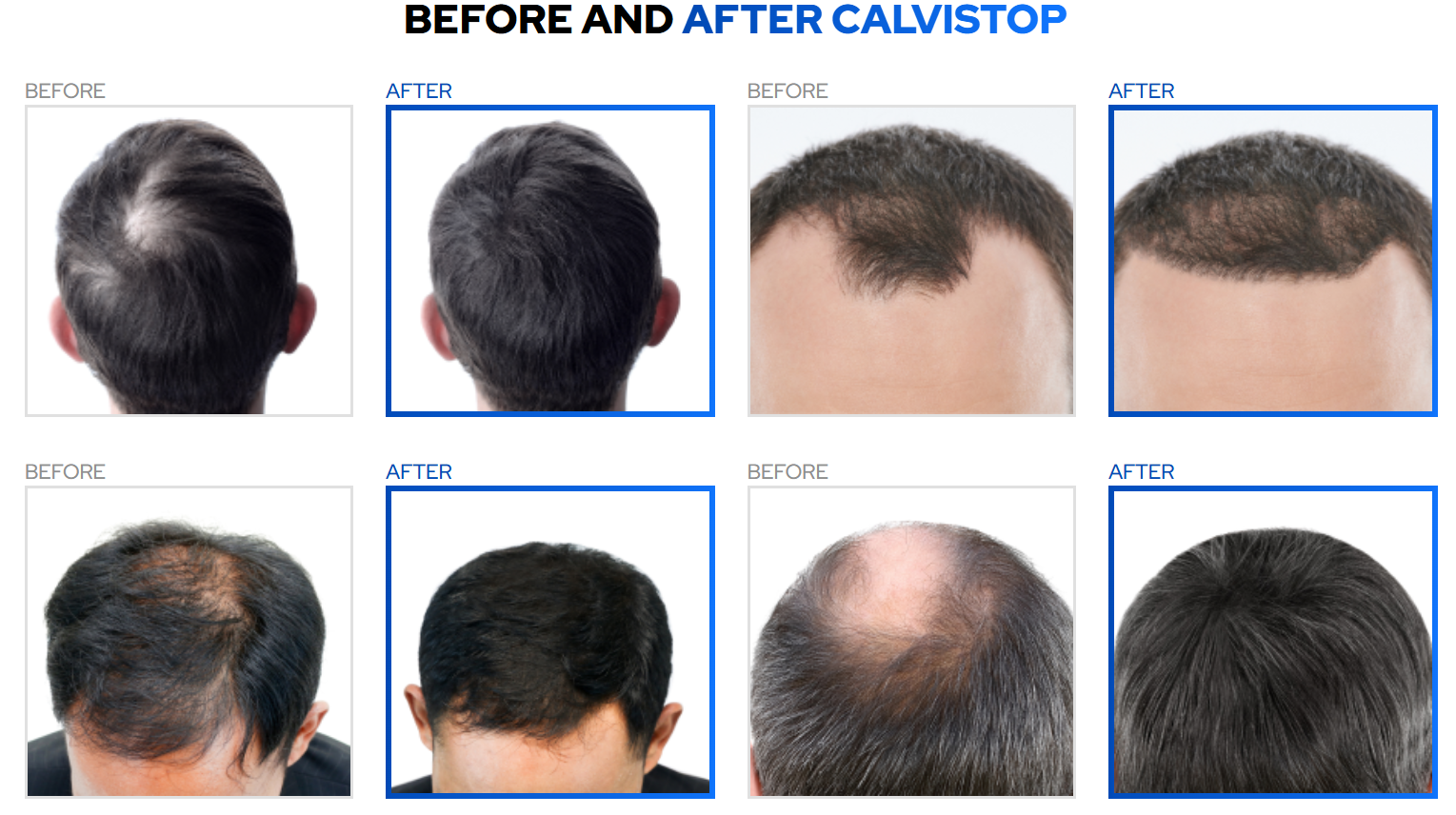 Calvistop Hair Loss Treatment Spary